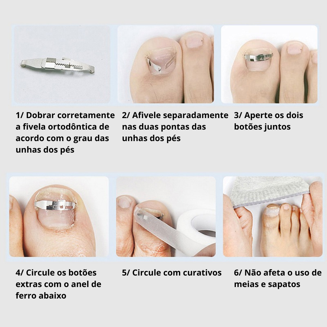 Kit Completo Para Desencravar Unhas | Clean Max + Brinde Exclusivo đ